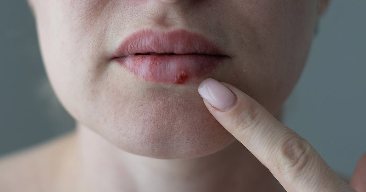 Una pastilla para el herpes que no responde: la FDA aprobó un antiviral que llevaba casi treinta años en falta